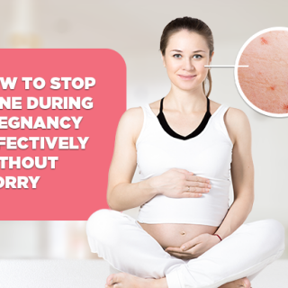 How to Stop Acne During Pregnancy Effectively Without Worry